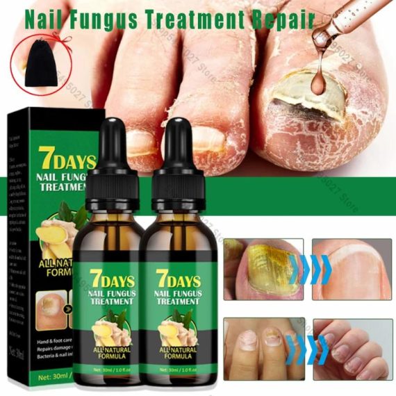 Consumer Electronics | 30Ml Repair Nail Fungus Treatments Essence Foot Care Serum Toe Nails Fungal Removal Gel Anti-Infection Onychomycosis Care Tool Consumer Electronics Consumer Electronics