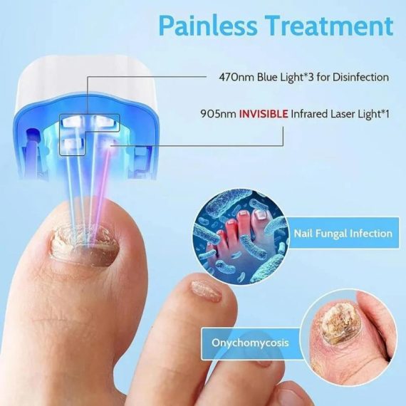 Consumer Electronics | Nail Fungus Laser Treatment Device Repair Toenail Fingernail Fungus Treat Onychomycosis Therapy Cure Machine Effectively Remove Consumer Electronics Consumer Electronics