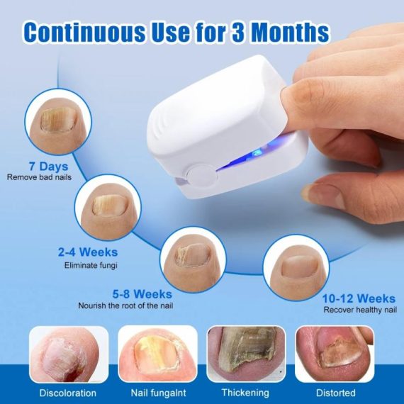 Consumer Electronics | Nail Fungus Laser Treatment Device Repair Toenail Fingernail Fungus Treat Onychomycosis Therapy Cure Machine Effectively Remove Consumer Electronics Consumer Electronics