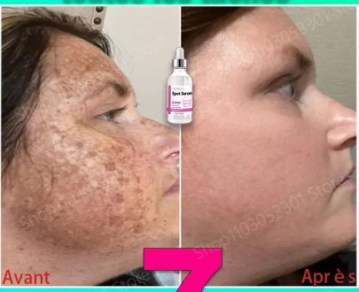 Health & Beauty | Anti-Freckle Serum Restores Skin Collagen Remove Facial Spots, Dark Spots, Chloasma, Sun Spots, Whitening And Freckle Removal Consumer Electronics Consumer Electronics